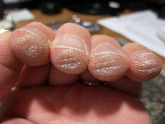 Sore fingers