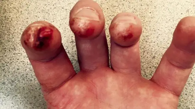 Violinist's bloody fingers after Shostakovich